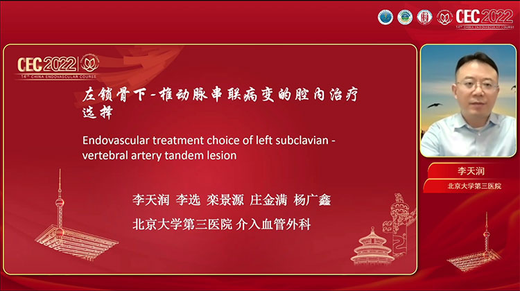 左锁骨下动脉-椎动脉串联病变的腔内治疗术式选择-李天润