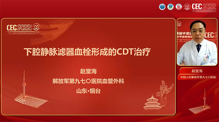 下腔静脉滤器血栓形成的CDT治疗-赵堂海