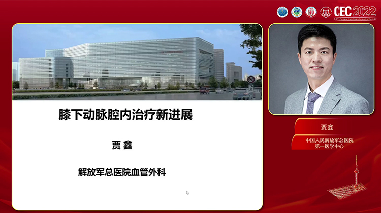 膝下动脉腔内治疗新进展-贾鑫