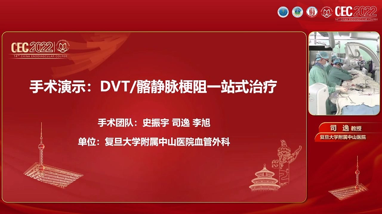 DVT髂静脉狭窄一站式治疗-史振宇 司逸