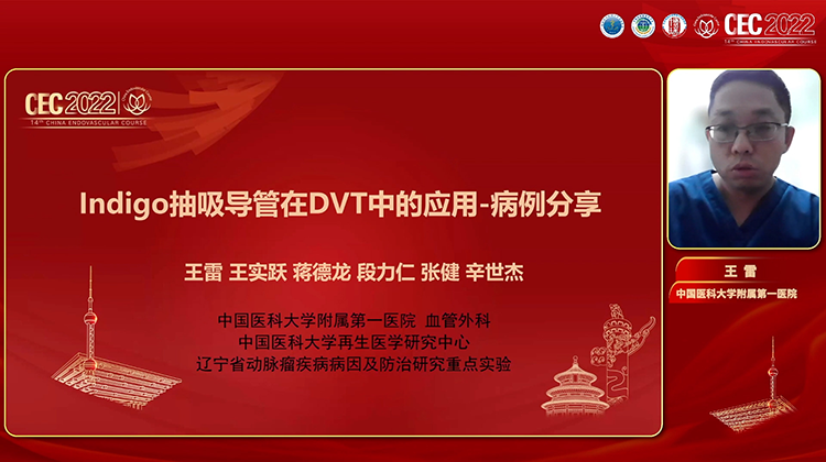 Indigo在DVT血栓清除中的应用-王雷