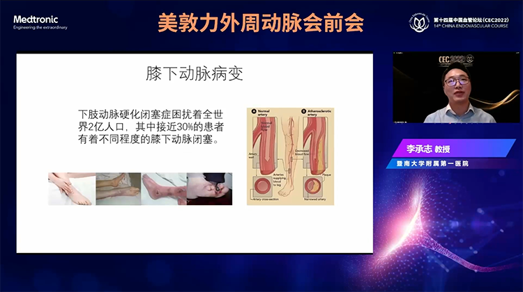 膝下动脉CTO病变腔内治疗经验分享-李承志