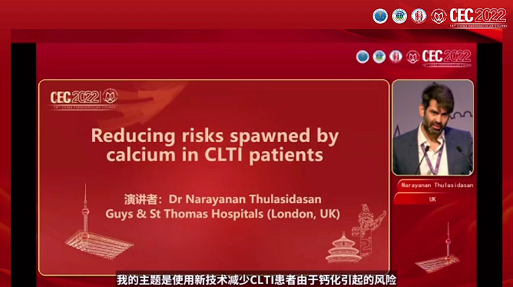 在慢性肢体威胁性缺血（CLTI）病人中降低钙化病变带来的风险 Reducing risks spawned by calcium in CLTI patients -Narayanan Thulasidasan