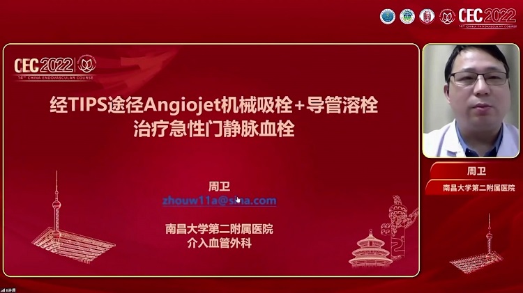 经TIPS途径Angiojet机械吸栓+导管溶栓治疗急性门静脉血栓-周卫