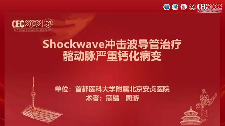 Shockwave冲击波导管治疗髂动脉严重钙化病变-寇镭 周游