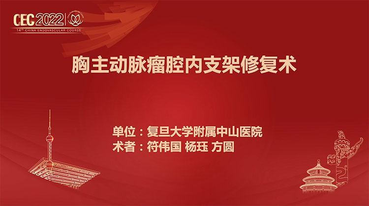 胸主动脉瘤腔内支架修复术-符伟国 杨珏