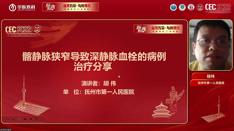 髂静脉狭窄导致深静脉血栓的病例治疗分享-胡伟