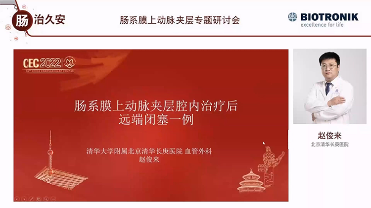 肠系膜上动脉夹层腔内治疗后远端闭塞一例-赵俊来