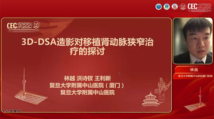3D-DSA造影对移植肾动脉狭窄治疗的探讨-林越