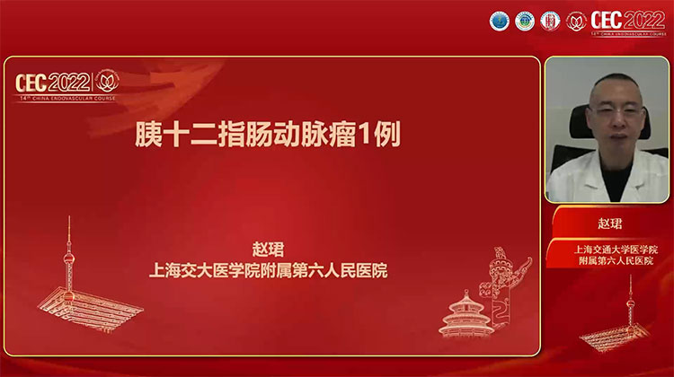 胰十二指肠动脉瘤1例-赵珺