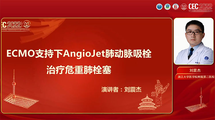 ECMO支持下AngioJet肺动脉吸栓治疗危重肺栓塞-刘震杰