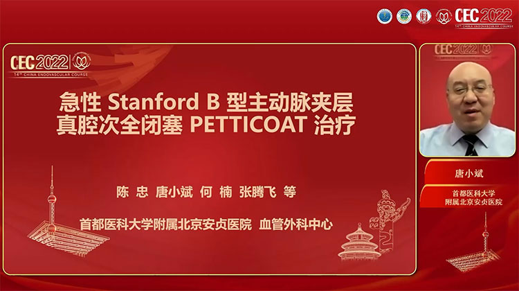 急性Stanford B型主动脉夹层真腔次全闭塞PETTICOAT治疗-唐小斌
