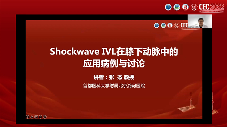 Shockwave IVL在膝下动脉中的应用病例与讨论-张杰