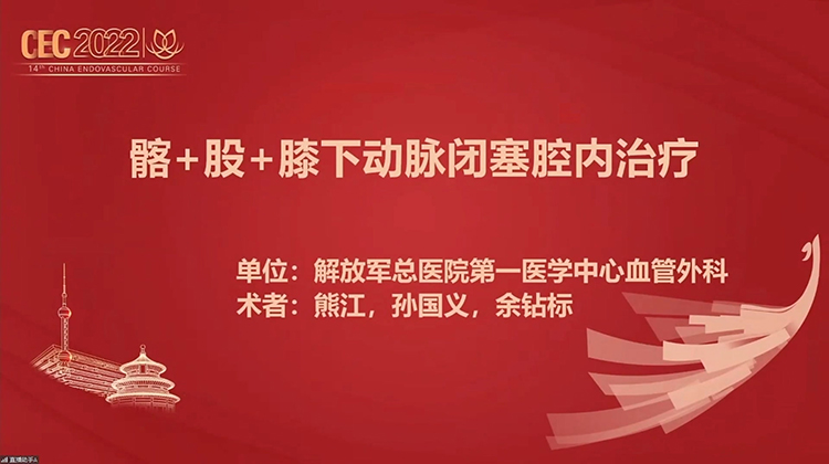 髂＋股＋膝下动脉闭塞腔内治疗-熊江，孙国义 
