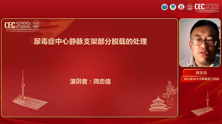 覆膜支架脱载移位的处理-周忠信