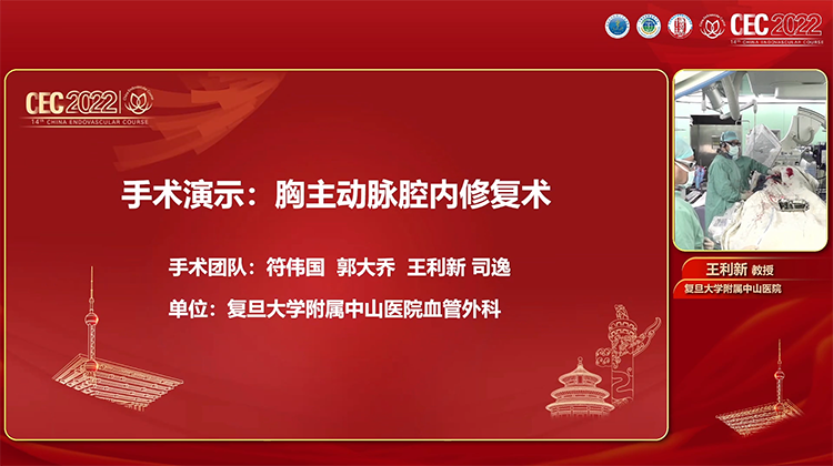 手术演示：唯强 Fabulos 胸主动脉腔内修复术-符伟国 郭大乔 王利新