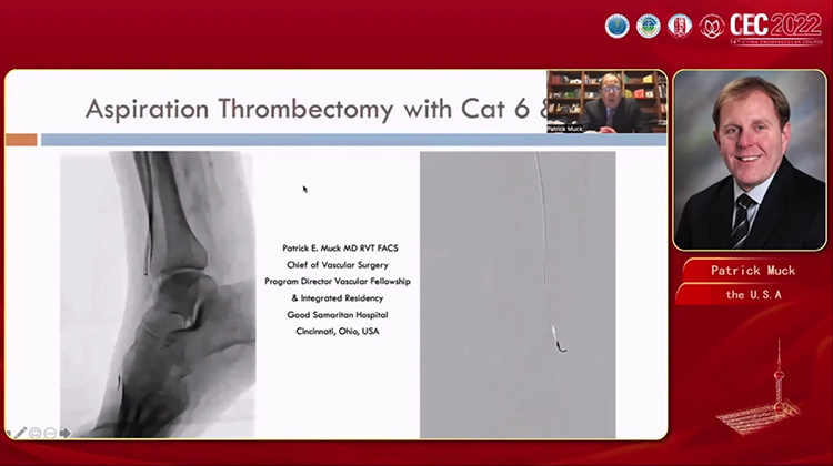 血栓清除再思考：机械抽栓技术与智能设备应用 Rethinking Thrombus Removal Mechanical Thrombectomy and New Intelligent Aspiration-Patrick Muck