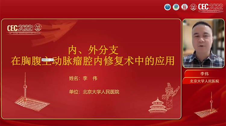 内、外分支在胸腹主动脉瘤腔内修复术中的应用-李伟