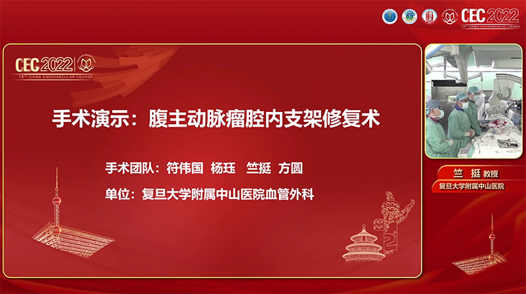 手术演示-心脉Minos腹主动脉瘤腔内支架修复术-符伟国 杨珏