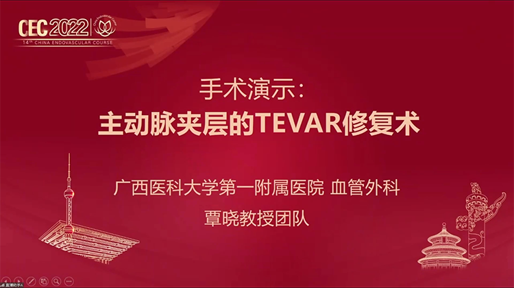 心脉Castor 主动脉夹层TEVAR修复术-覃晓