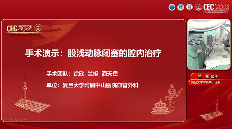 手术演示：股浅动脉闭塞的腔内治疗-徐欣，竺挺