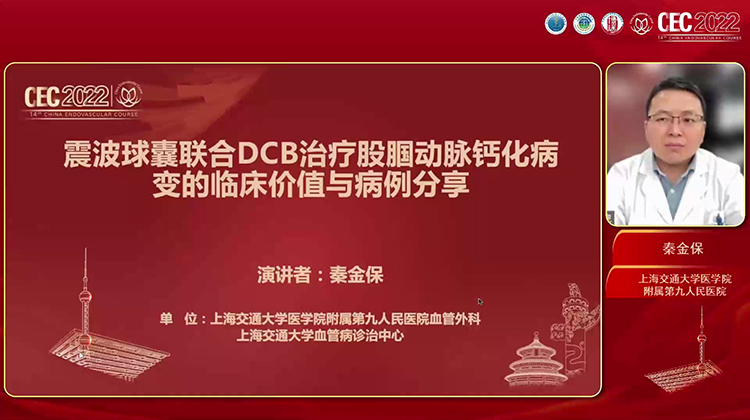 震波球囊联合DCB治疗股腘动脉钙化病变的临床价值与病例分享-秦金保