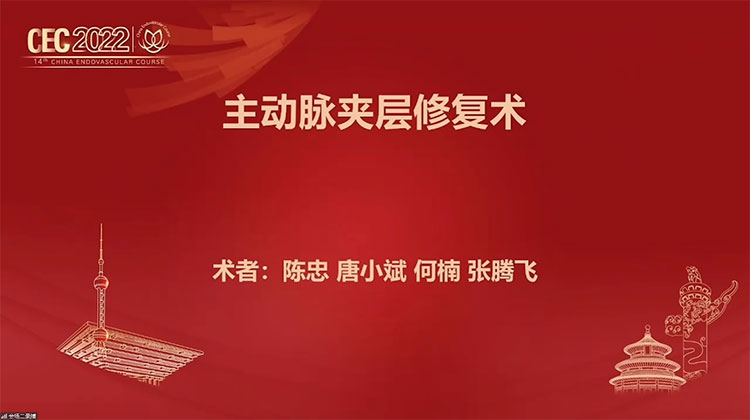 唯强Fabulos 主动脉夹层腔内修复术中的应用-陈忠，唐小斌