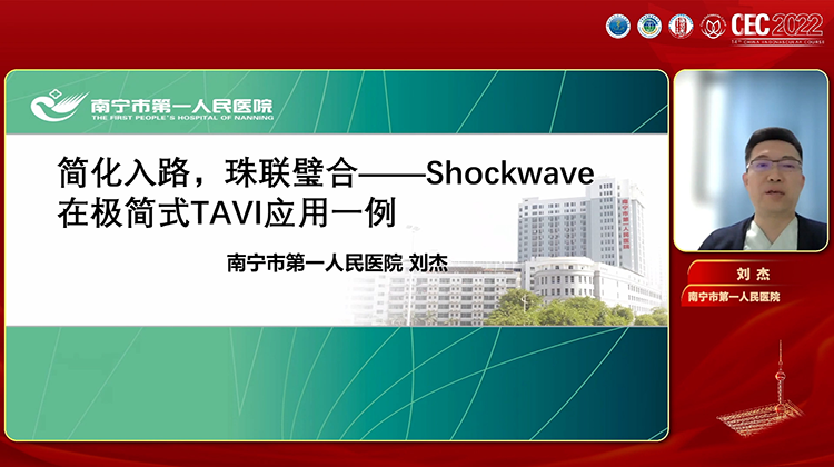 Shockwave在极简式TAVI应用一例-刘杰