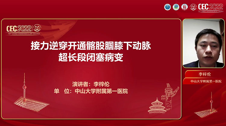 接力逆穿开通髂股腘膝下动脉超长段闭塞病-李梓伦