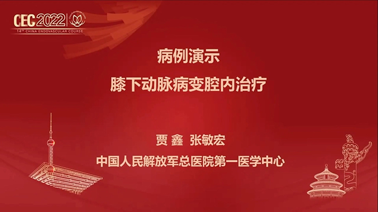 病例演示：膝下动脉病变腔内治疗-贾鑫，张敏宏