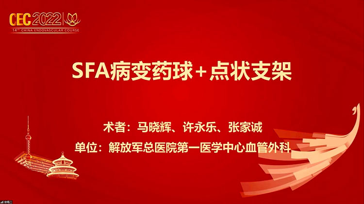 SFA病变药球+点状支架-马晓辉