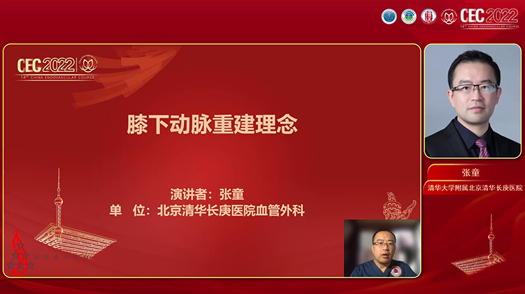 膝下动脉重建理念-张童
