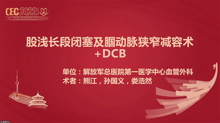 Tubohawk 股浅长段闭塞及腘动脉狭窄减容术+DCB-熊江，孙国义