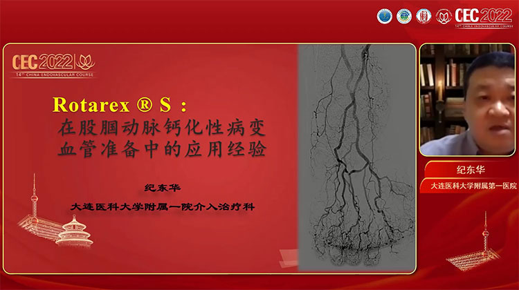 Rotarex &reg; S在股腘动脉钙化性病变血管准备中的应用经验-纪东华
