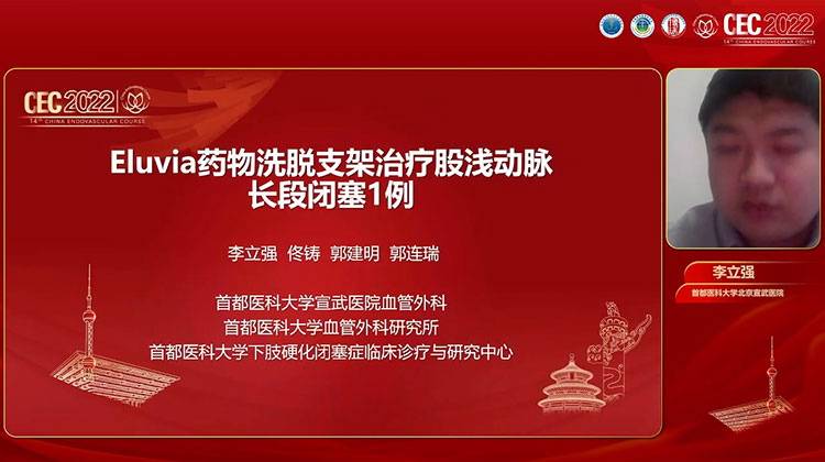 Eluvia药物洗脱支架治疗股浅动脉长段闭塞一例-李立强