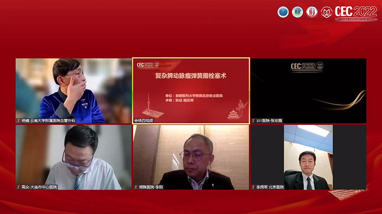 复杂脾动脉瘤弹簧圈栓塞术-张征 刘晖