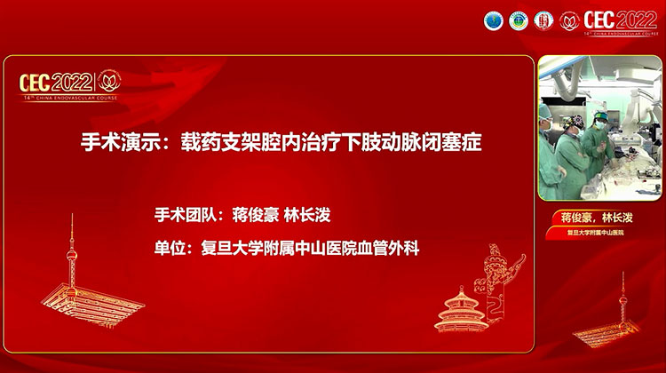 载药支架腔内治疗下肢动脉闭塞症-蒋俊豪