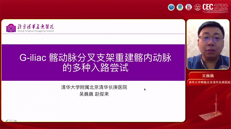 G-iliac髂动脉分叉重建髂内动脉的多种入路尝试-吴巍巍