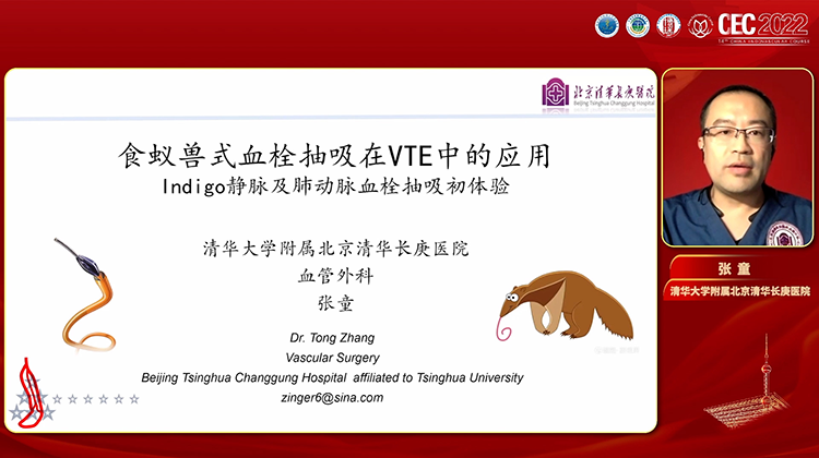 持续负压抽吸Indigo在VTE中的临床应用-张童