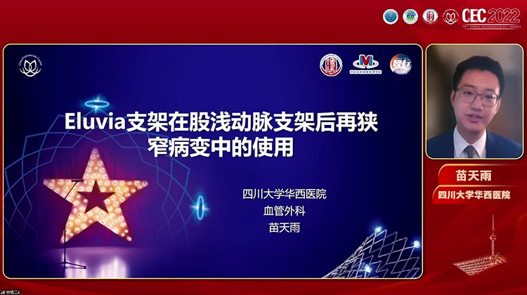 Eluvia支架在股浅动脉支架后再狭窄病变中的使用-苗天雨