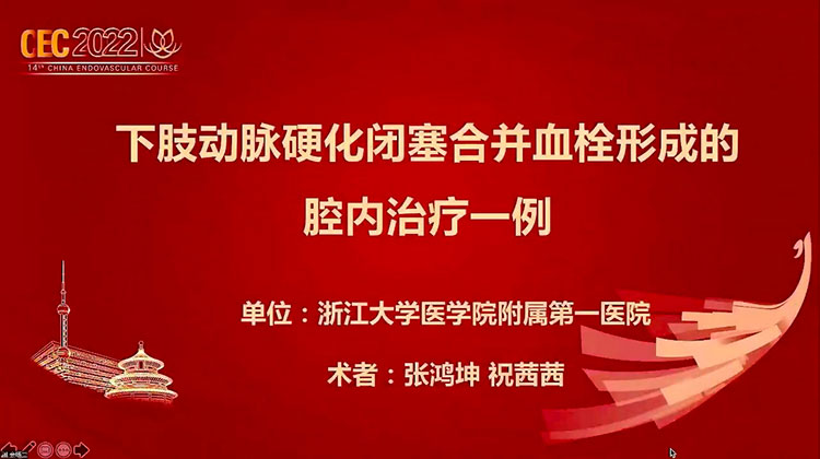 下肢动脉硬化闭塞合并血栓形成的腔内治疗一例-张鸿坤