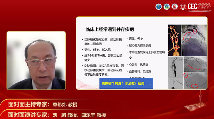 颈动脉重度狭窄伴不稳定心绞痛时的处理原则-刘鹏