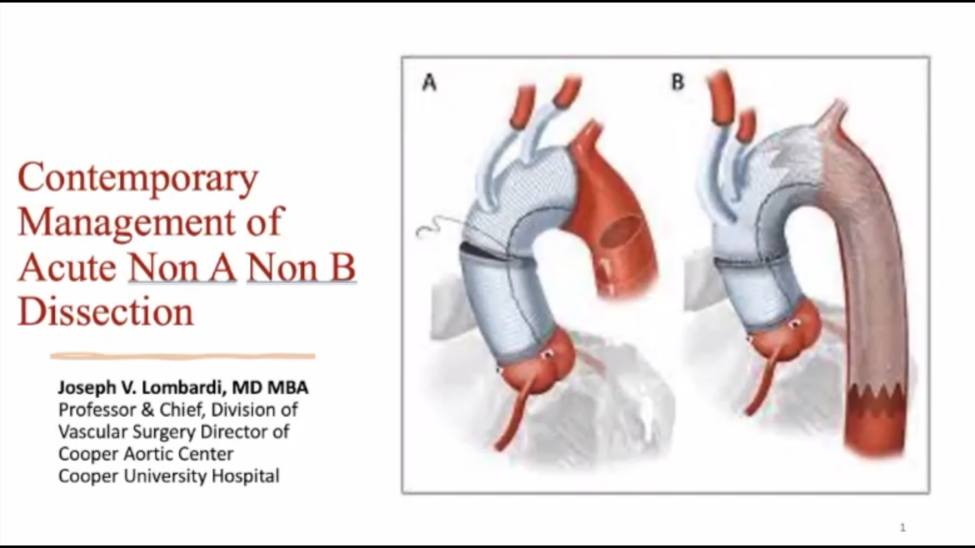 急性非A非B型主动脉夹层的当前治疗方式--Joseph Lombardi