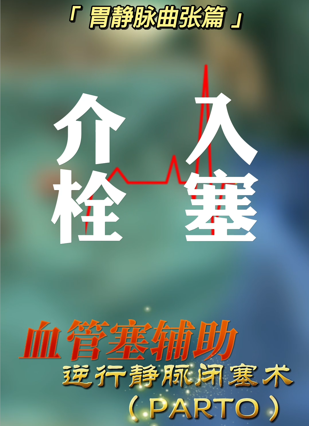 介入栓塞篇｜胃静脉曲张